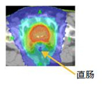 前列腺癌症