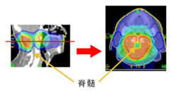 头颈部癌症